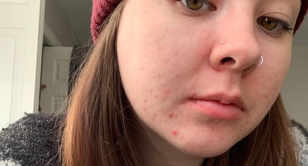 Girl with hormonal acne on face