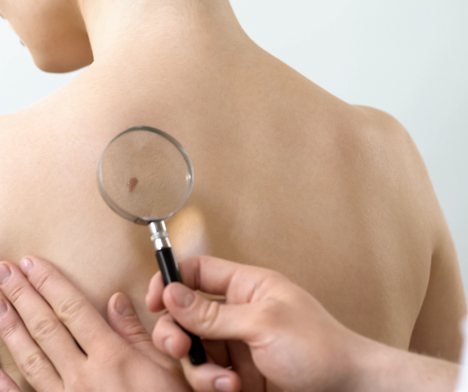 Person being monitored for skin cancer