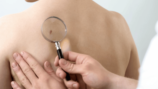 skin cancer magnifying glass